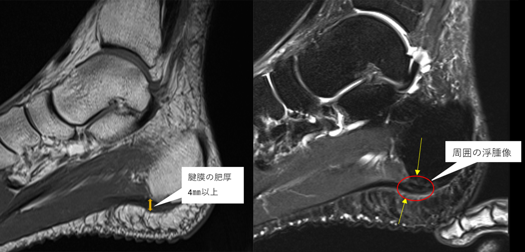 足底腱膜症のMRI画像