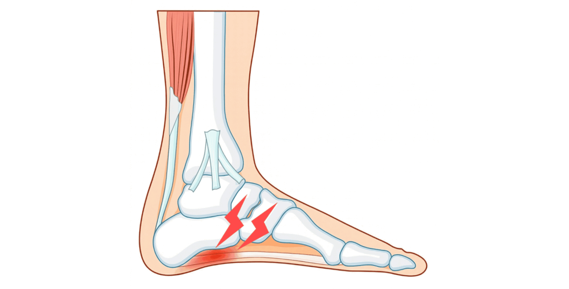 足底腱膜症で痛む部位