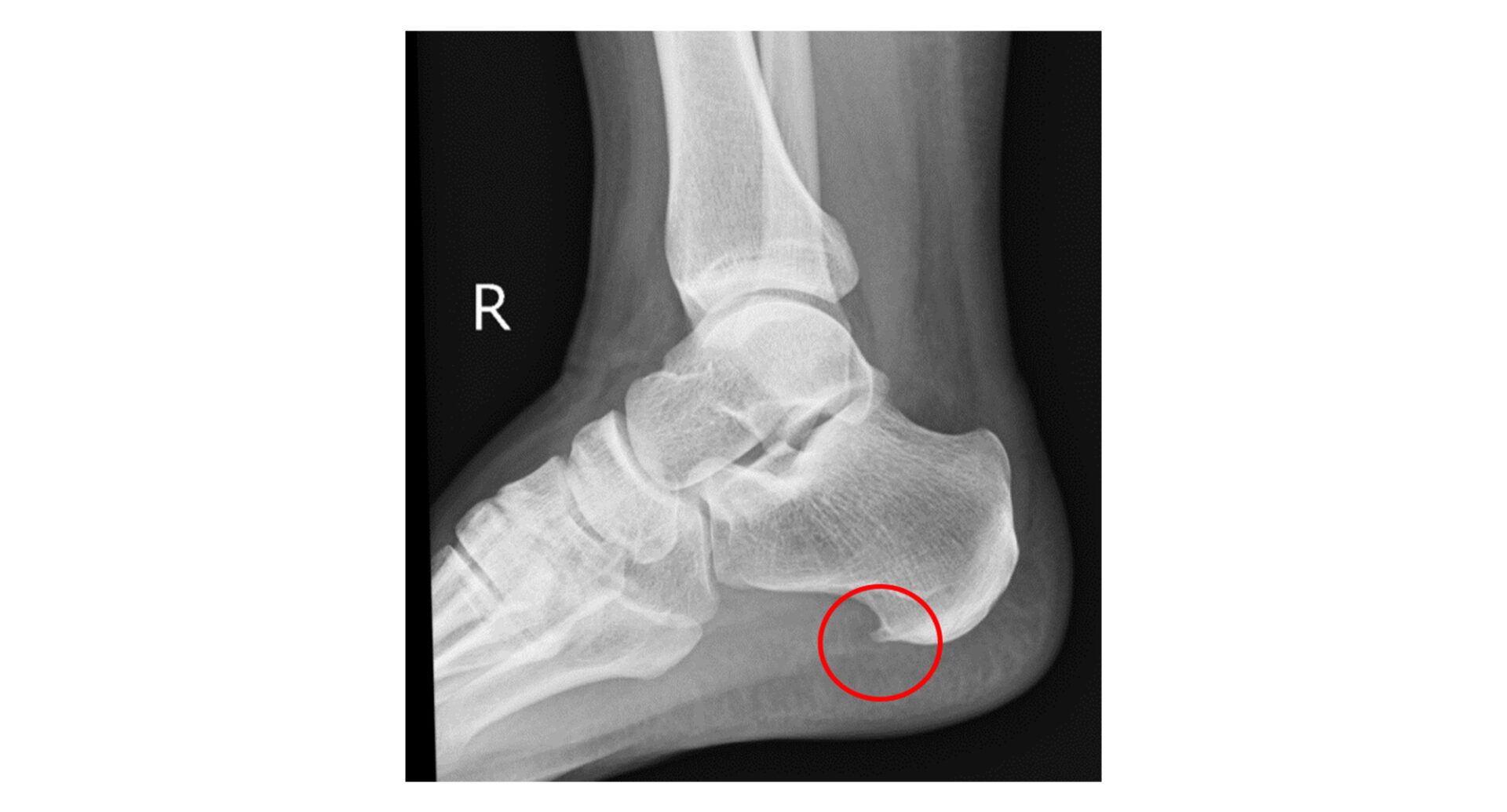 足底腱膜症のレントゲン（X線）画像