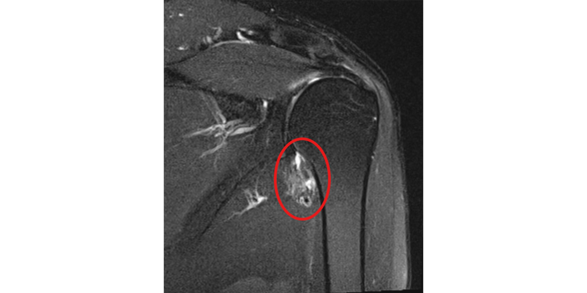 肩関節周囲炎のレントゲン画像