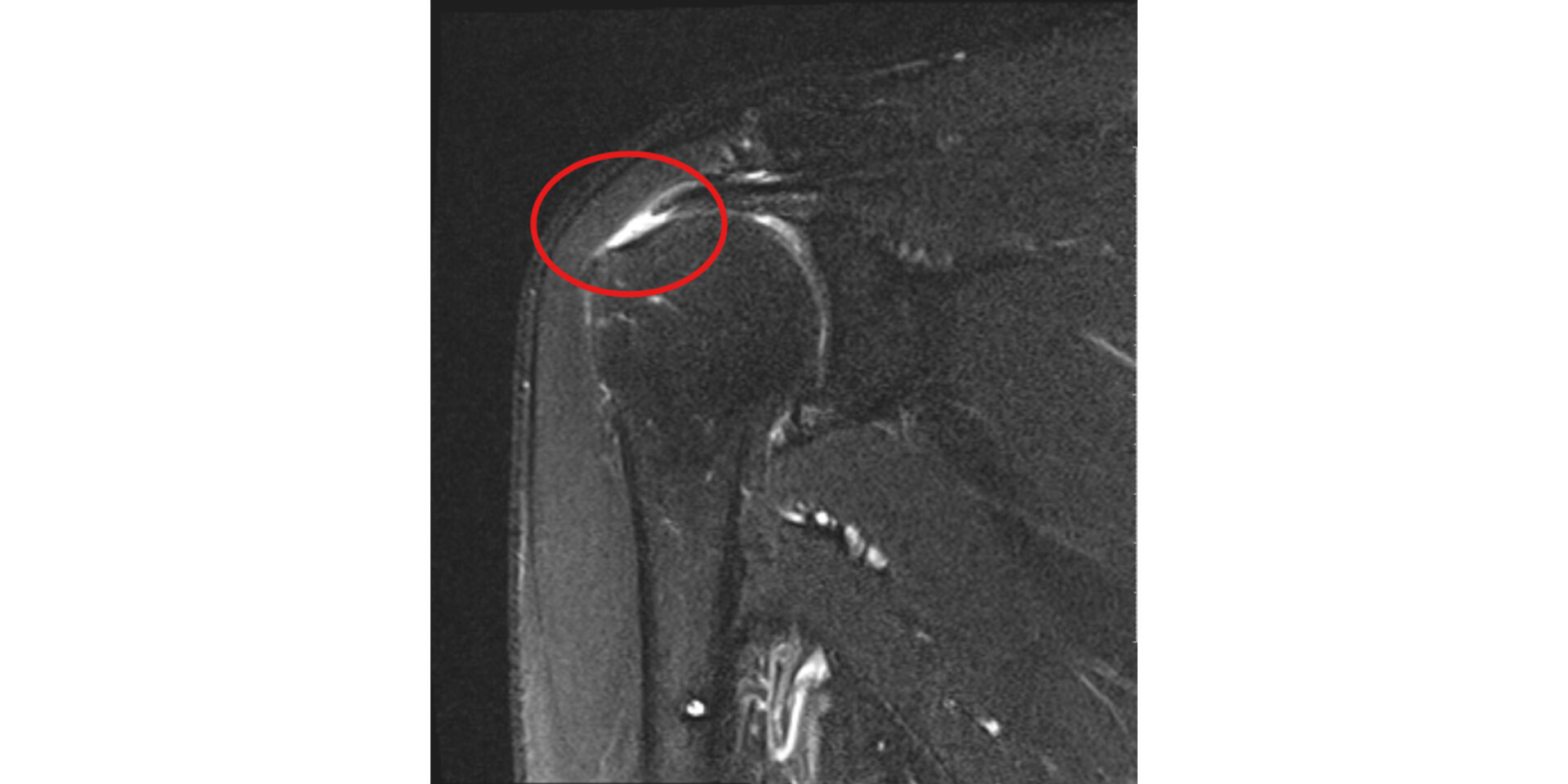 腱板断裂のレントゲン画像