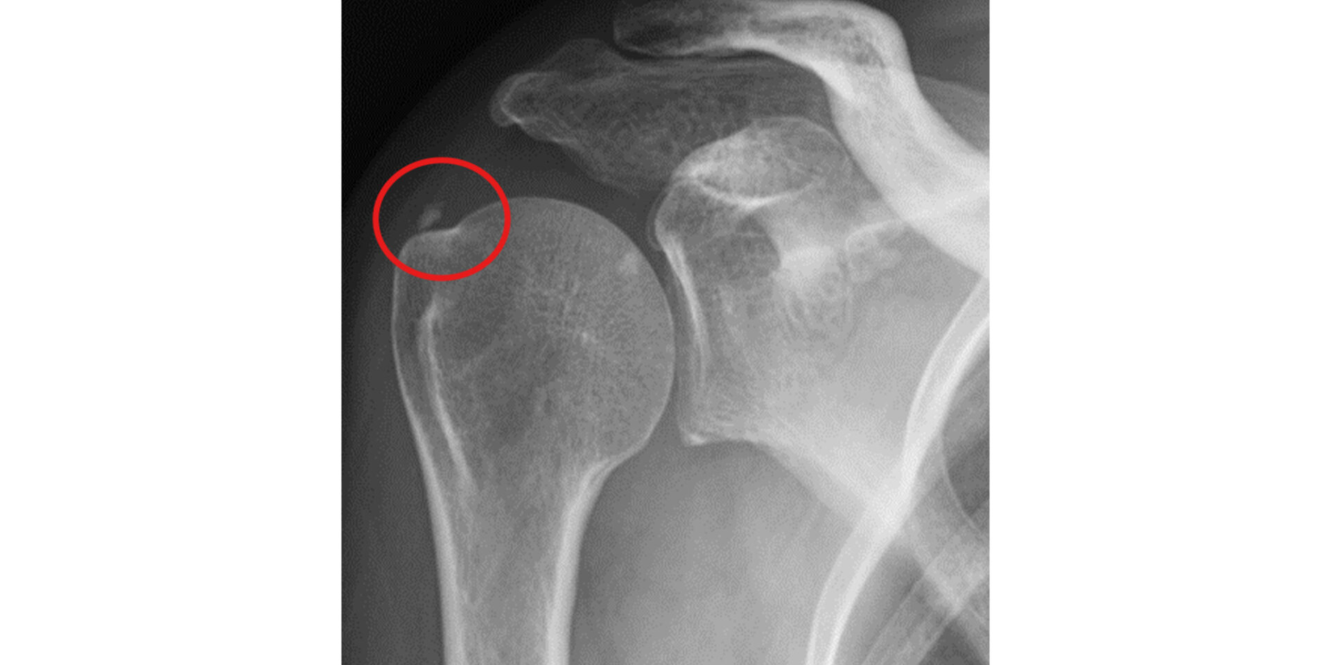 石灰沈着性腱板炎のレントゲン画像