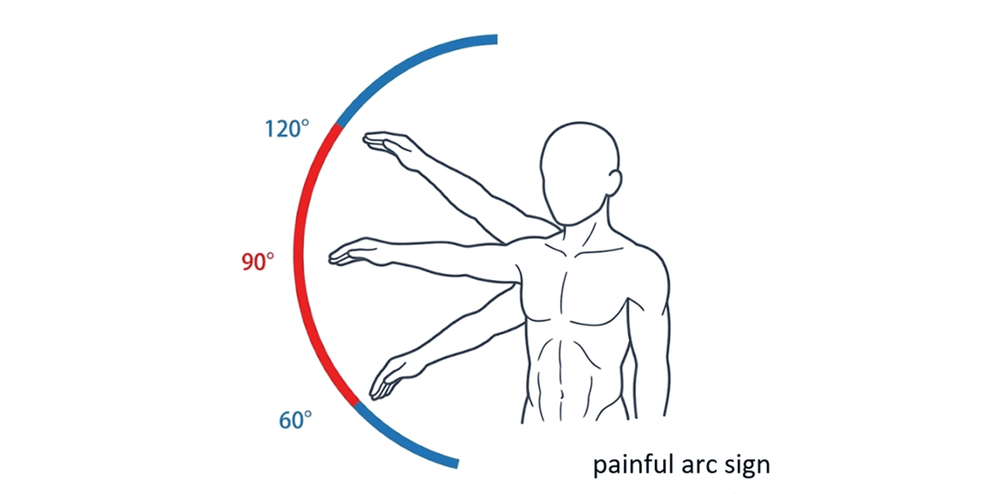 ペインフル・アーク・サインの診断イメージ