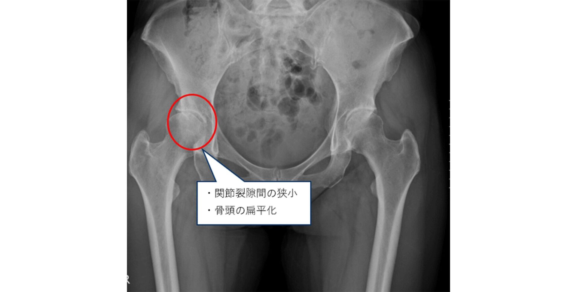 変形性股関節症のレントゲン画像