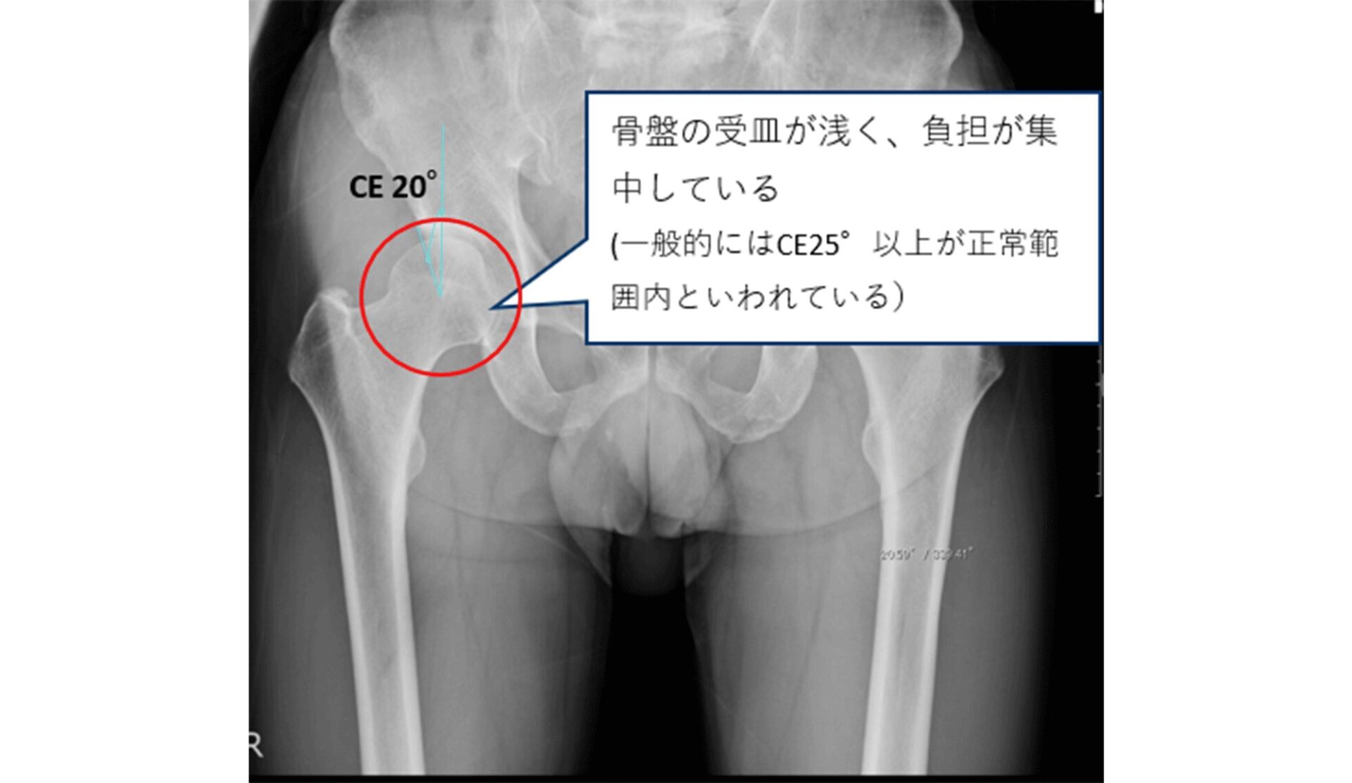 寛骨臼形成不全のレントゲン画像