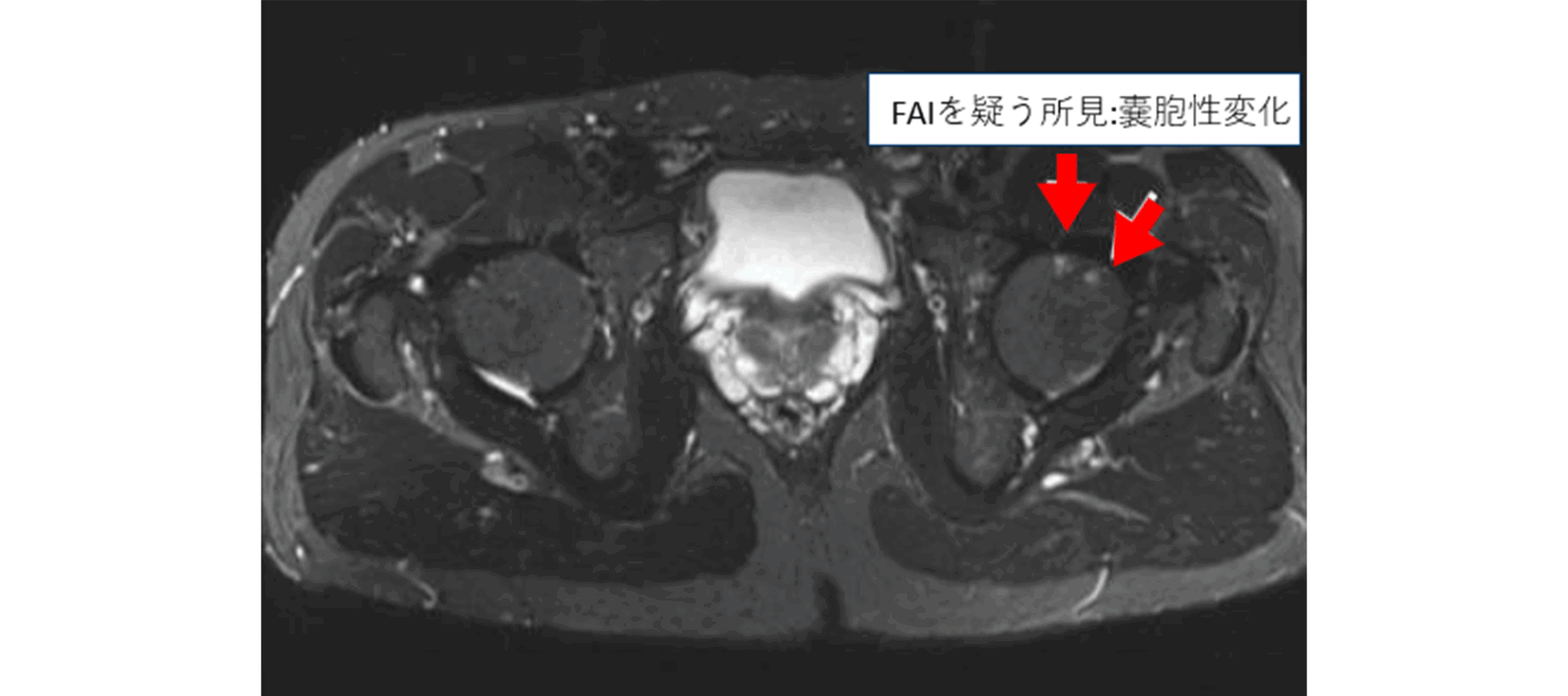 cam型FAI(大腿骨寛骨臼インピンジメント)のレントゲン画像