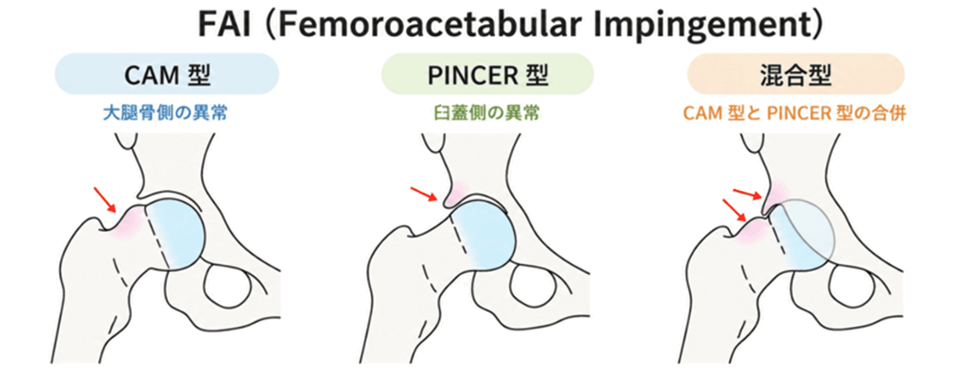 cam型FAI（大腿骨寛骨臼インピンジメント）のイラスト