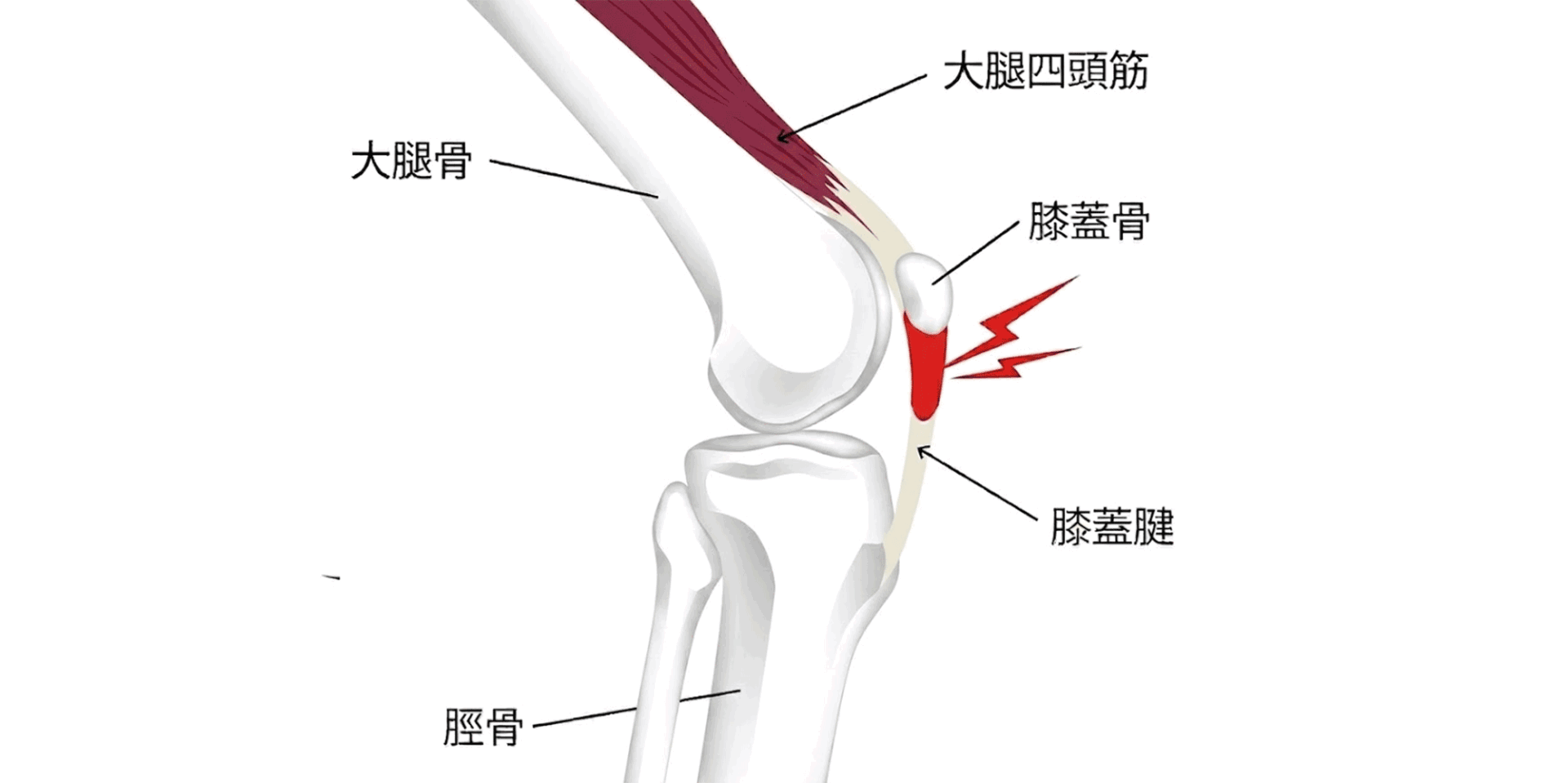 膝蓋腱炎(ジャンパー膝)のイメージ図