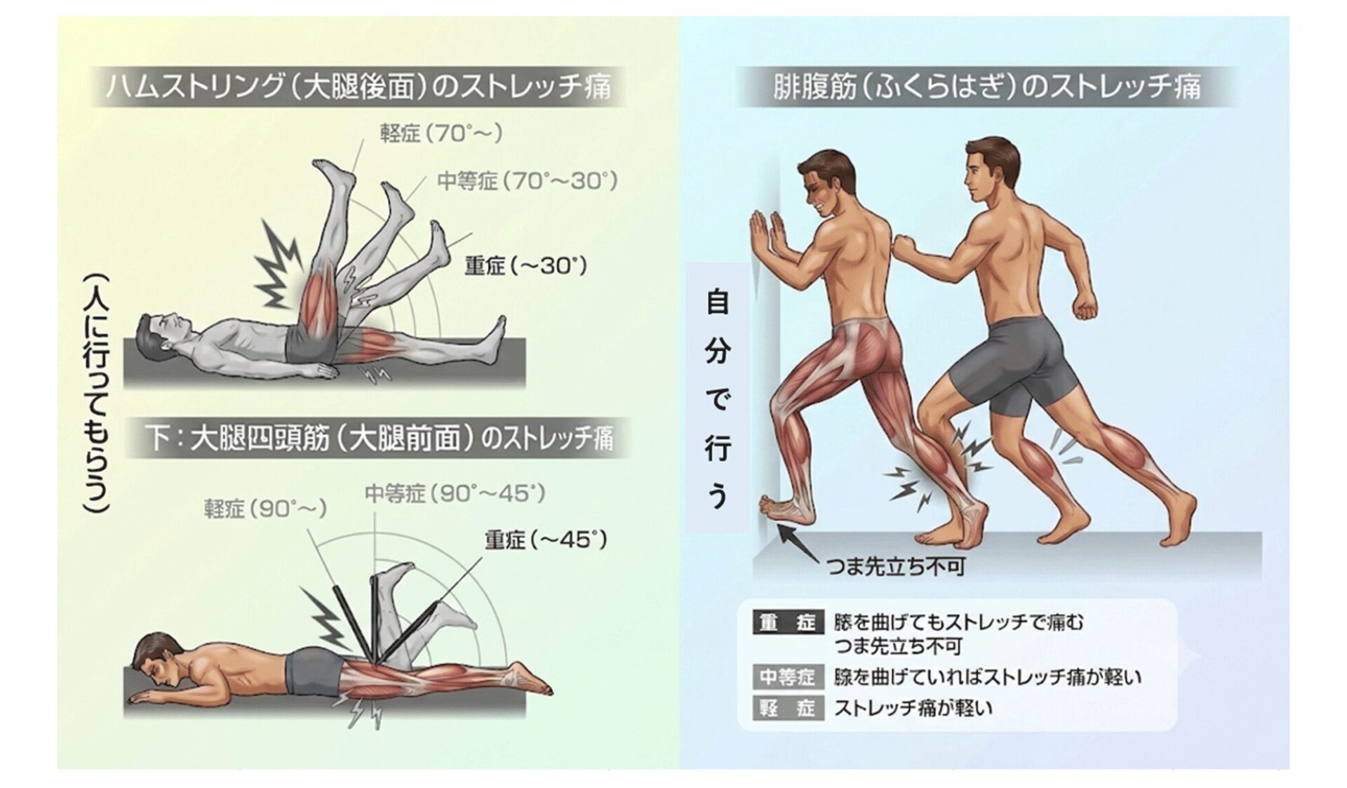 肉離れの重症度の見分け方